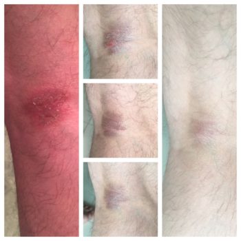 knee rash improvements